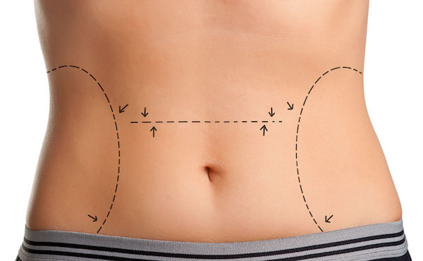 Maximizing Mini Tummy Tuck Before and After Results