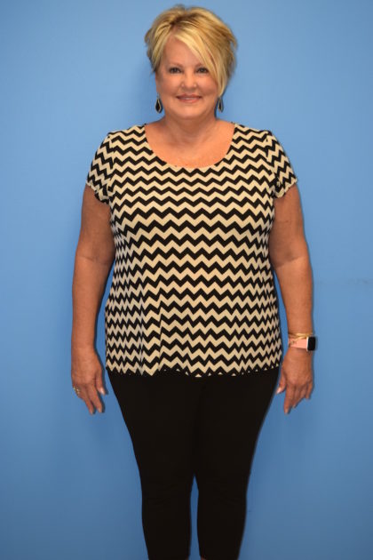 Patient 538 Gastric Sleeve Before And After Photos Houston Plastic