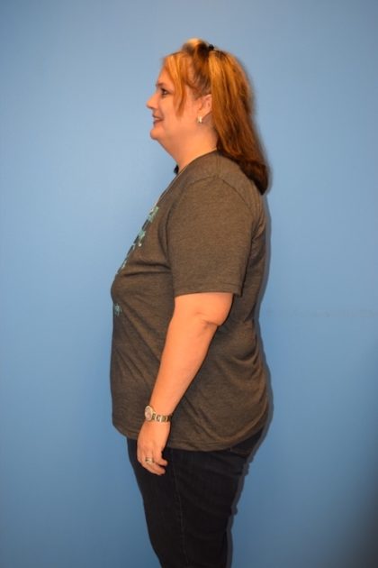 Patient 645 Gastric Sleeve Before And After Photos Houston Plastic